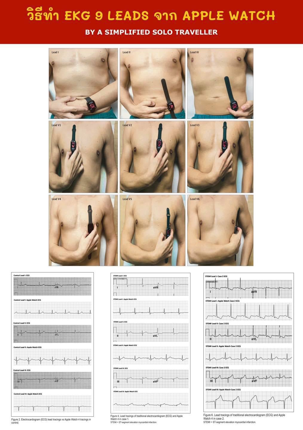 ❤️ เชื่อมั้ยว่า Apple Watch ทำ EKG 9 leads ได้ ?&nbsp;❤️